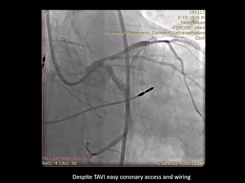 Left main (bifurcation) PCI using DK Crush technique through a Navitor TAVI