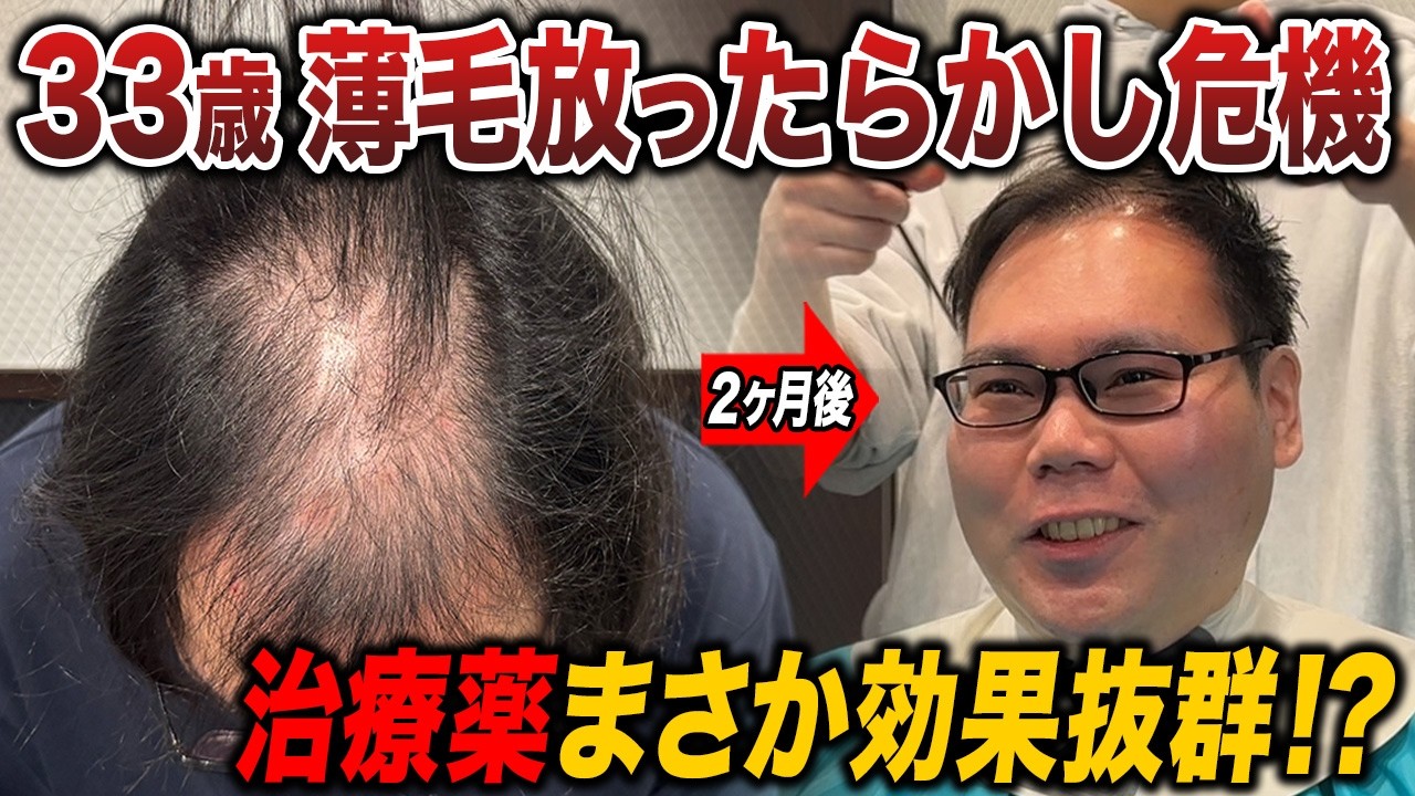 【AGA治療2ヶ月】薄毛を放っておいた男性の結果が衝撃的!?
