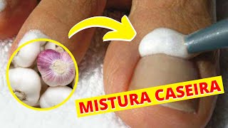 Como Tratar Micose de Unhas com Remédio Caseiro