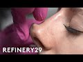 I Tried A Non Surgical Nose Job Macro Beauty Refinery29