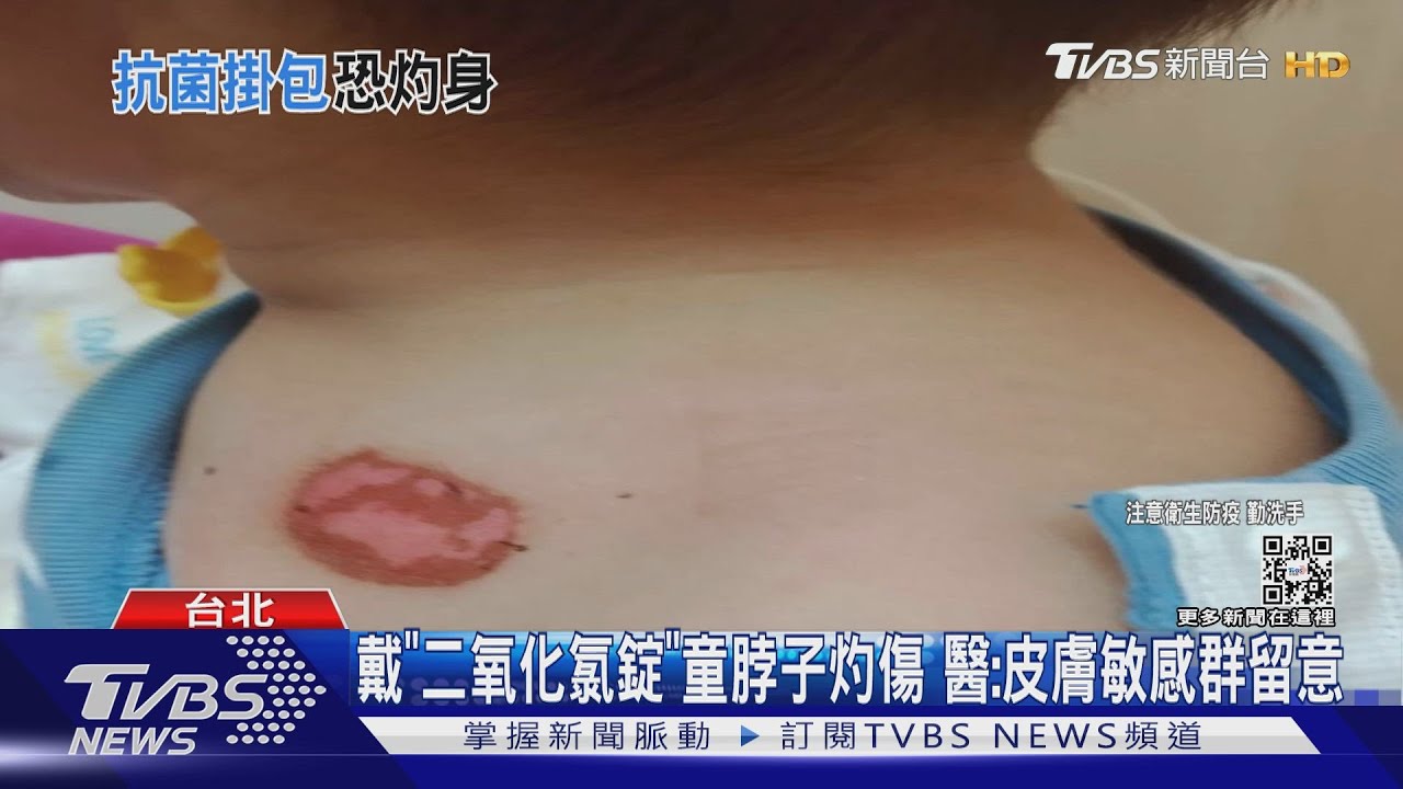 戴「二氧化氯錠」童脖子灼傷　醫：皮膚敏感群留意