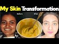 From Dark Acne Prone Skin To Bright Glass Skin My Full Skin Transformation Journey