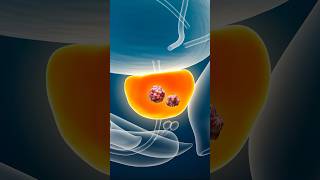 Download lagu How fast does prostate cancer grow — and is it treatable? mp3 Download lagu How fast does prostate cancer grow — and is it treatable? mp3