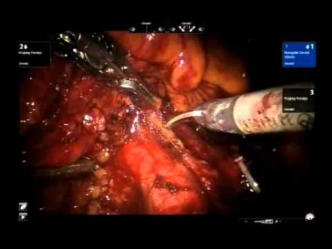 Laparoscopic Radical Cystectomy - Extended Pelvic Lymphadenectomy With Robot Assist