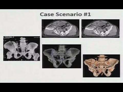 MTAC January 2020 Hemorrhagic Pelvic Fractures