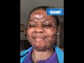 Watch Her Amazing Skin Transformation Journey From Freckled Face To Smooth With SAAM Skincare