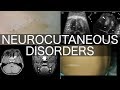 Neurocutaneous Disorders