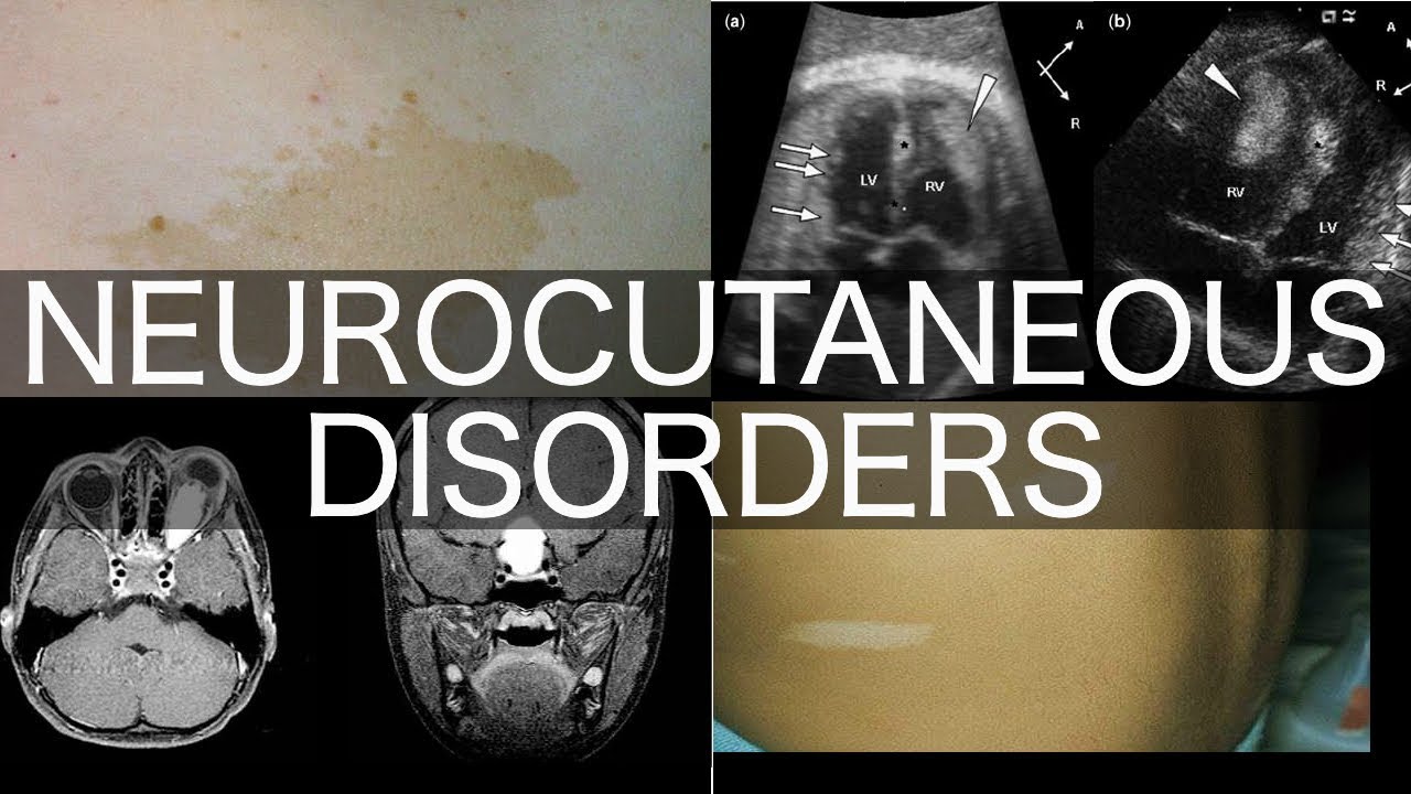 Neurocutaneous Disorders