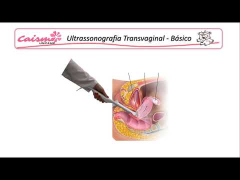 Fundamentos da ultrassonografia transvaginal