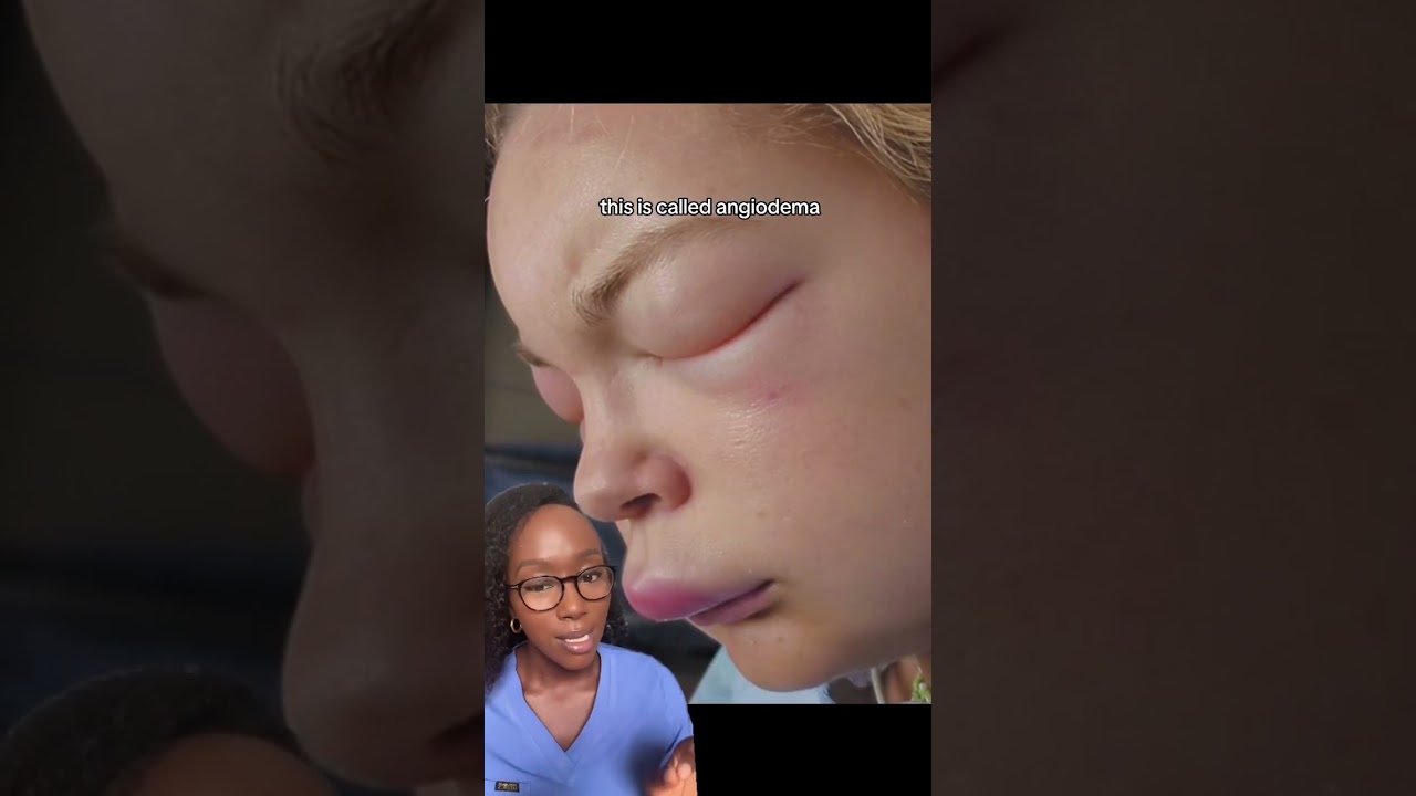 Urticaria (Hives or Welts) Causes, Signs, Diagnosis and Treatment