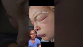 Urticaria (Hives or Welts) Causes, Signs, Diagnosis and Treatment