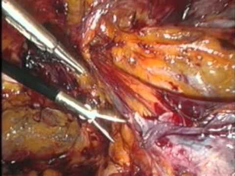Top 14 Part 7: Laparoscopic Inguinal Hernia Repair