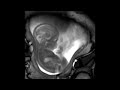 The Best 18 Mri Pregnancy Scan Photos