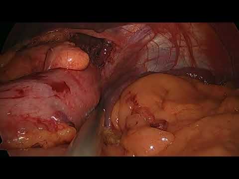 Revisional Laparoscopic Antireflux Surgery After Transoral Incisionless Fundoplication | CTSNet