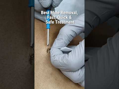 Fast, Quick & Safe Mole Removal | Doctor-Performed Electrocautery