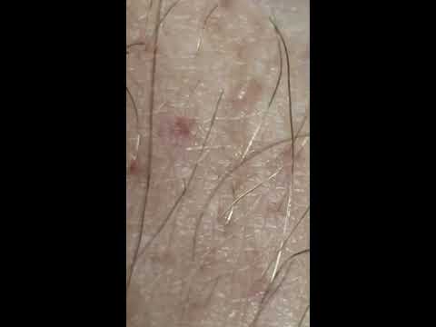 Morgellons and the Luminescent Biofilm