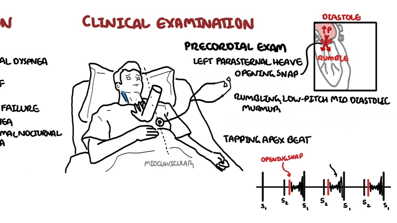 Mitral Stenosis - causes, pathophysiology and treatment