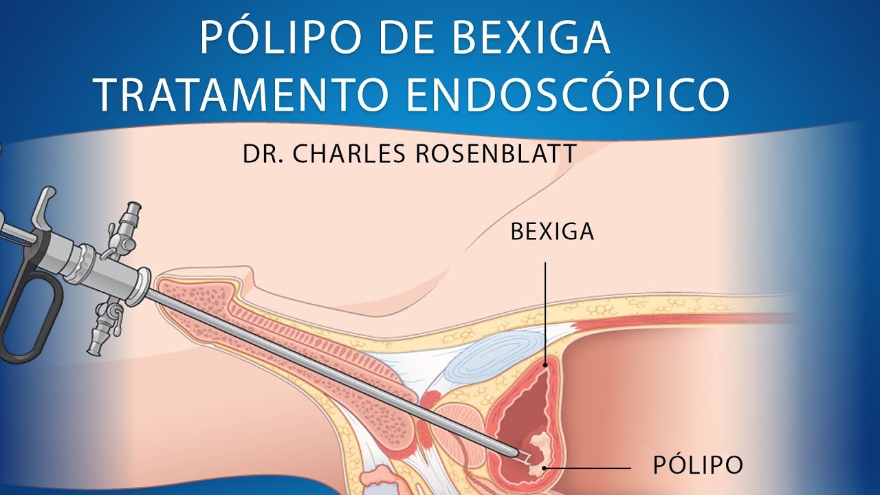 Pólipo de bexiga - tratamento endoscópico