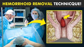 Hemorrhoid Removal Surgery (hemorrhoidectomy)