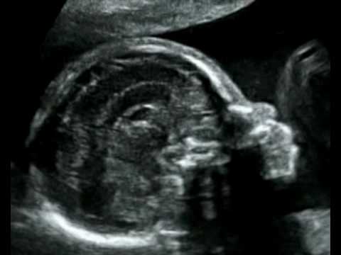 Fetal Medicine Foundation - Agenesis of corpus callosum