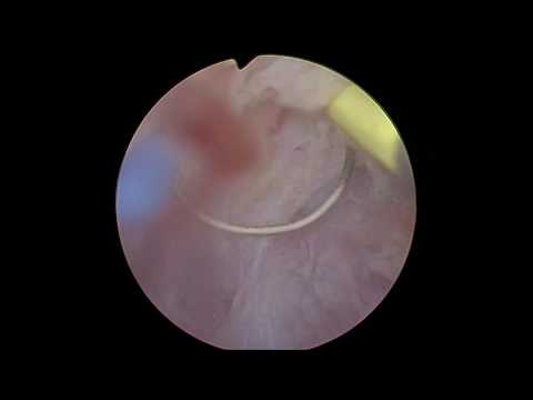 En Bloc Resection Of Bladder Tumor