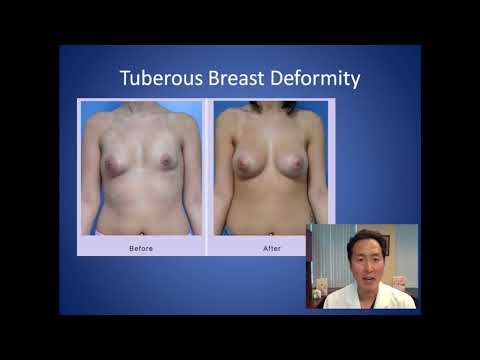 YouTube video about: Why are my breasts so far apart?