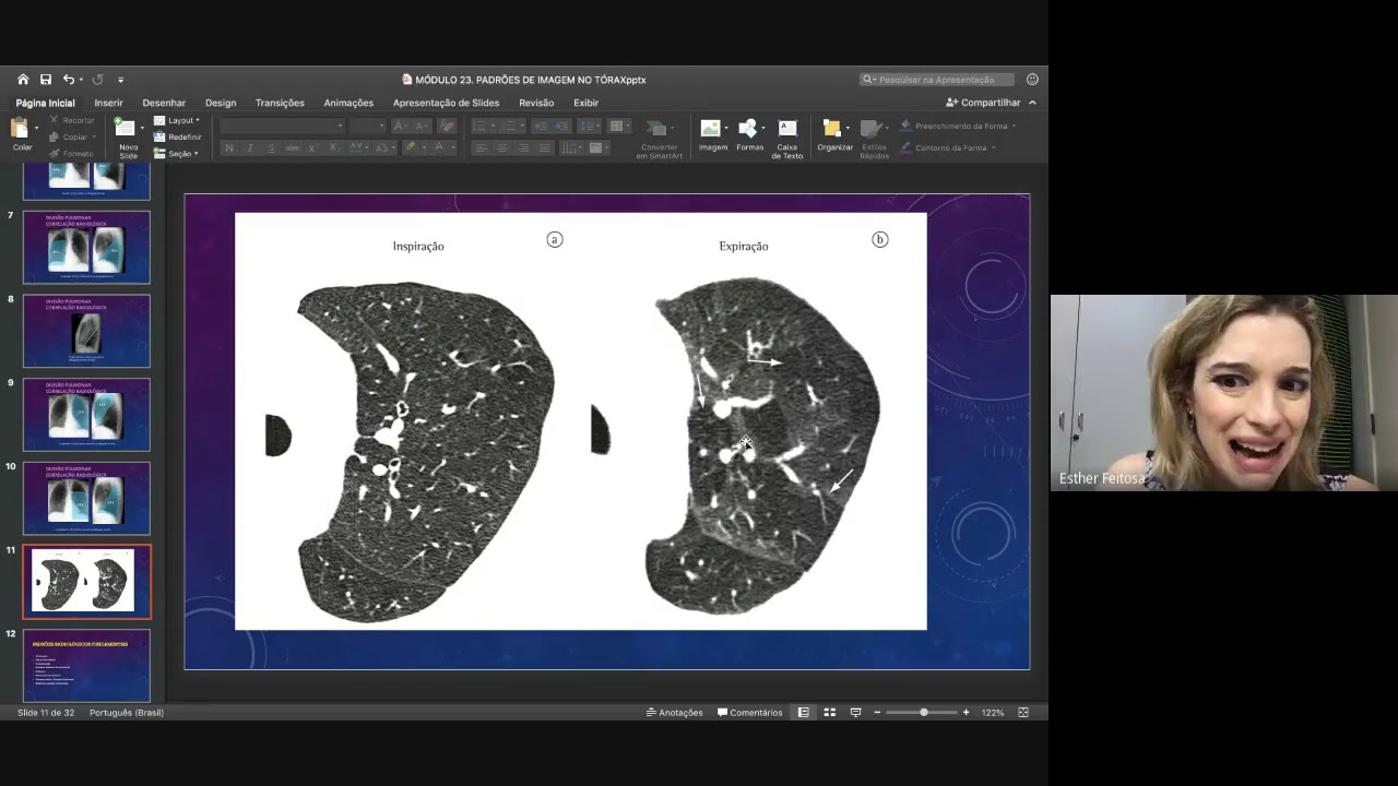 Padrões Radiológicos Clássicos na TC de tórax