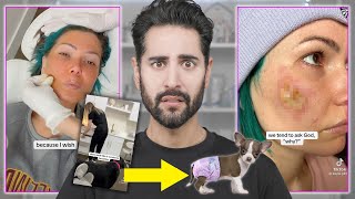 The TikTok Chemical Peel From Hell!