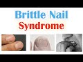 Brittle Nail Syndrome | Causes, Signs & Symptoms, Diagnosis, Treatment, Supplements