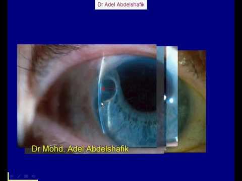 Slit lamp examination - whole presentation