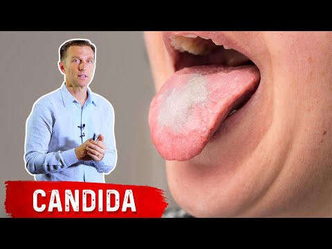High Carb Diets and White Tongue (Oral Thrush)