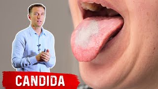 High Carb Diets and White Tongue (Oral Thrush)