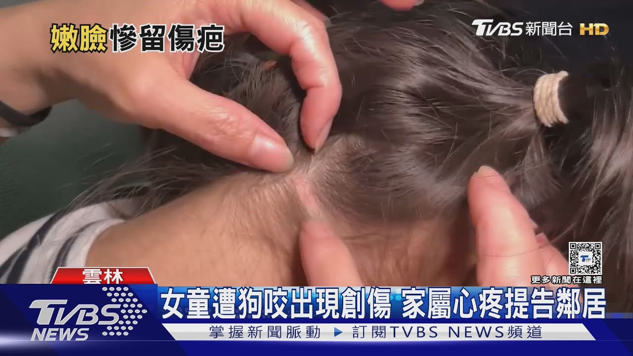 女童獨自走進鄰居家 遭秋田犬撕咬全身傷