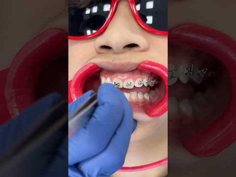 Watch how Metal Braces are put On