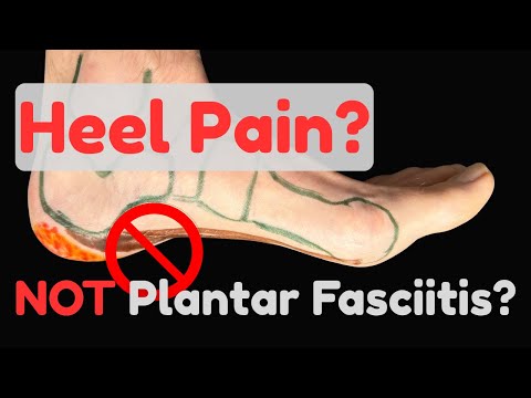 Still Have Heel Pain? 5 Problems That Are NOT Plantar Fasciitis