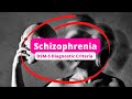 Schizophrenia | DSM-5 Diagnostic Criteria