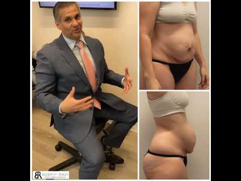 Severe Diastasis Recti Repaired During Dr. Ravi's Tummy Tuck Procedure