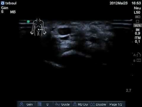 comment soigner tunnel carpien