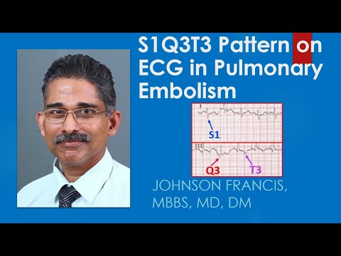 S1Q3T3 Pattern on ECG in Pulmonary Embolism