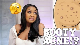 How to CLEAR BUTT ACNE FAST | Getting Rid of Body Acne, Scars, and Irritation!