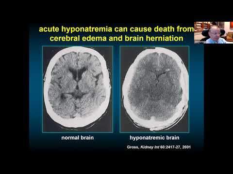 SIADH and Diabetes Insipidus