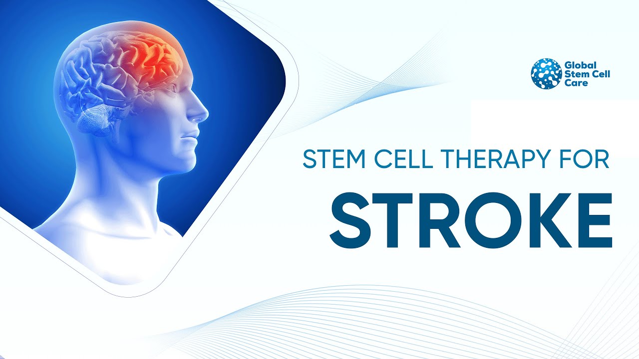 Stem Cell Therapy in Brain Stroke | Brain Stroke | Best Treatment For Brain Stroke | Stem Cells