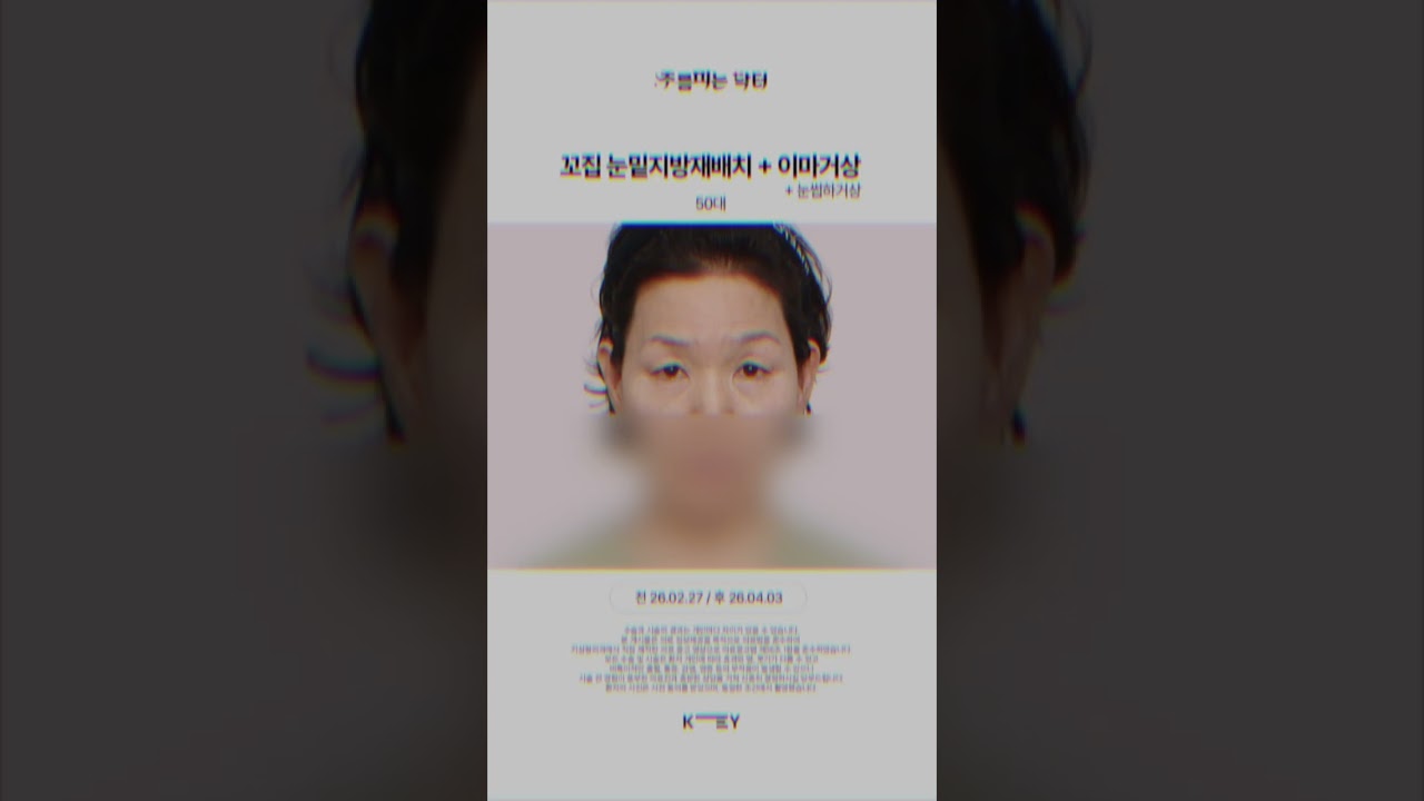 50대 눈주변(눈밑+눈위)