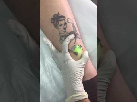 Laser Tattoo Removal