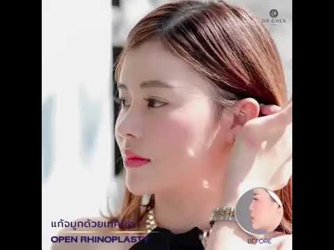 แก้จมูกเทคนิคโอเพ่น Dr. Chen แก้จมูกเทคนิคโอเพ่น Dr. Chen