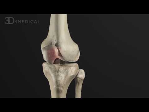 Anterior Cruciate Ligament: Pathology and Management | Animated Tutorial