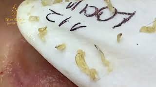 Loan Nguyen Acne Treatment #360
