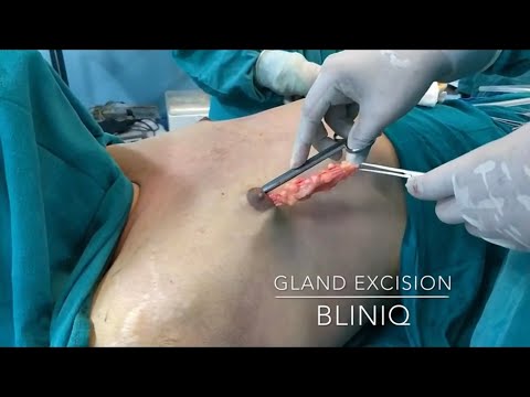 Patient Recovery Case — Video 9 (Gynecomastia)