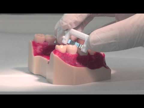 ContacEZ Restorative Strip System