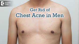 All about Pimples on Male Chest | Chest Acne:Causes & Best Cure-Dr. Rajdeep Mysore | Doctors